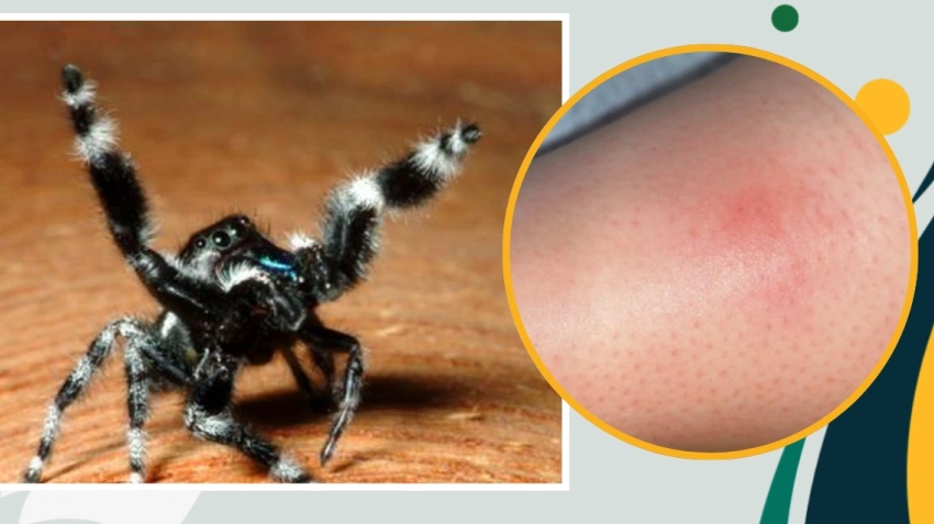 jumping spider bite treatment jumping spider bite treatment